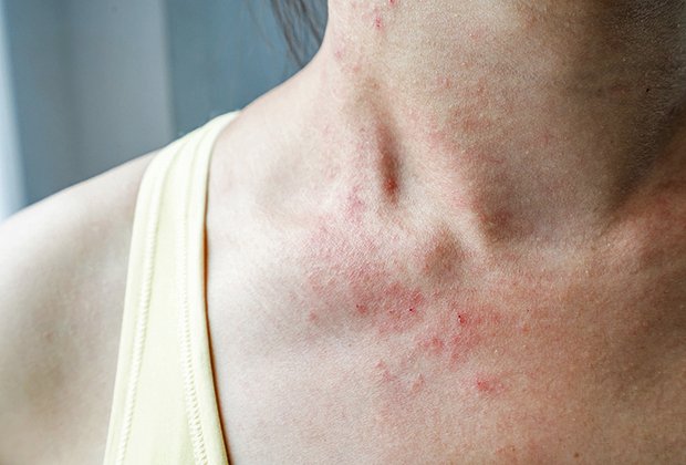 Экзема: симптомы у взрослых и детей, лечение заболевания