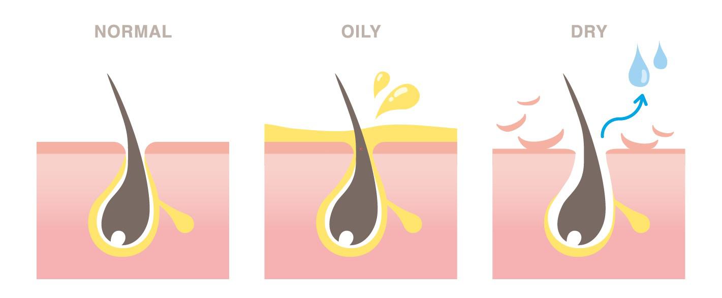 Конкретный тип кожи головы определяет генетика и уровень выработки подкожного сала